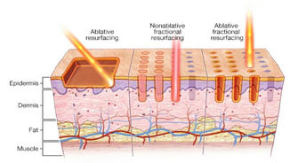 Laser Skin Resurfacing: How American Technology Rejuvenates Beauty