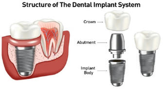 Maintenance and Care of Dental Implants